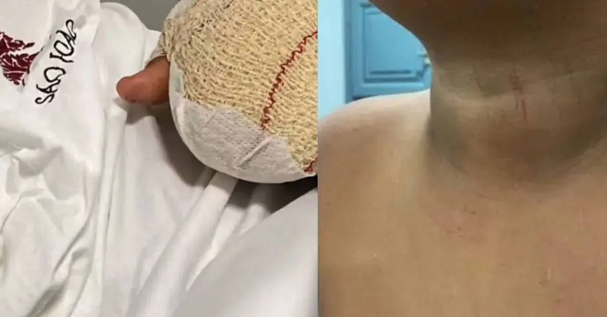 Apesar da gravidade dos ferimentos, a mãe relata que a escola inicialmente tentou tratar o caso como um simples acidente.