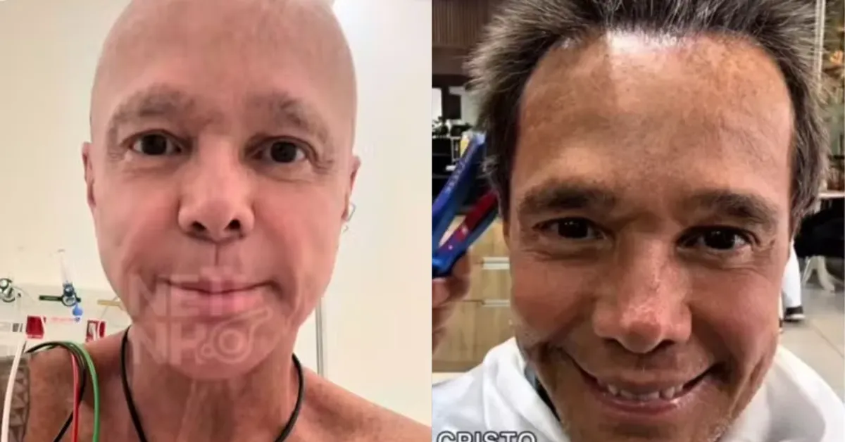 Netinho sorri ao mostrar o cabelo voltando a crescer após o tratamento contra o câncer.