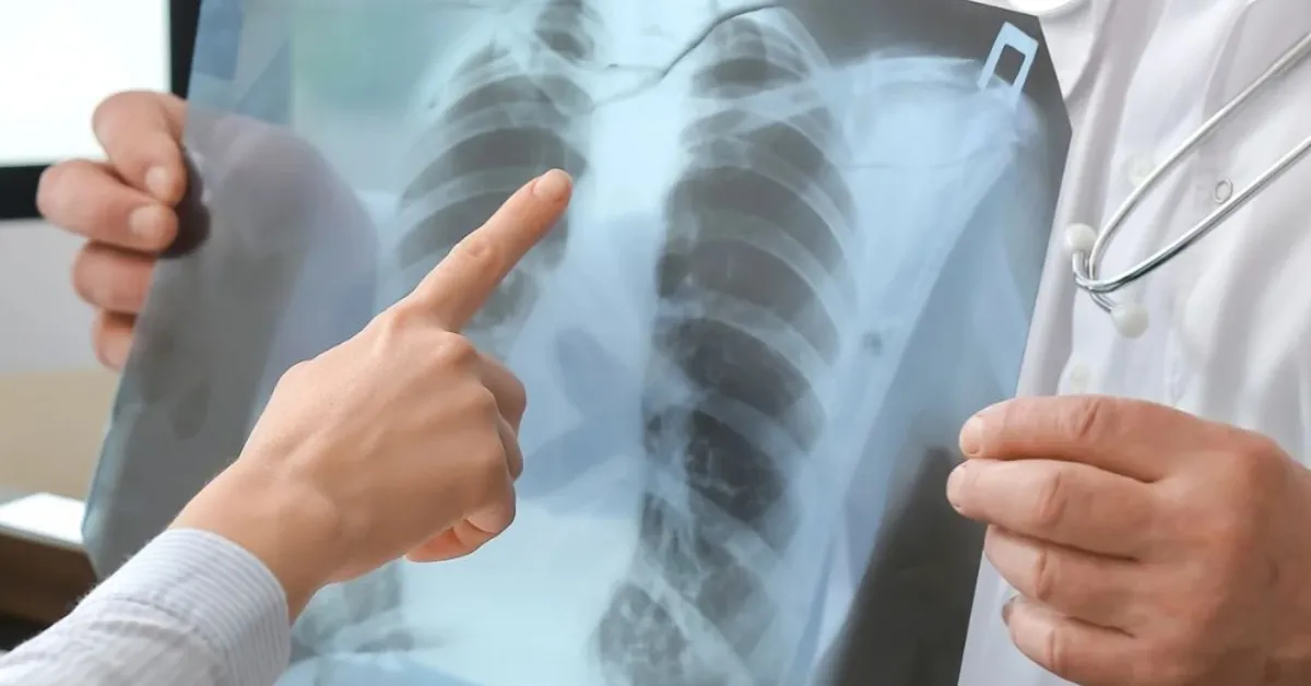 No Brasil, mais de 84 mil diagnósticos novos são notificados, desencadeando cerca de 6 mil mortes por ano.