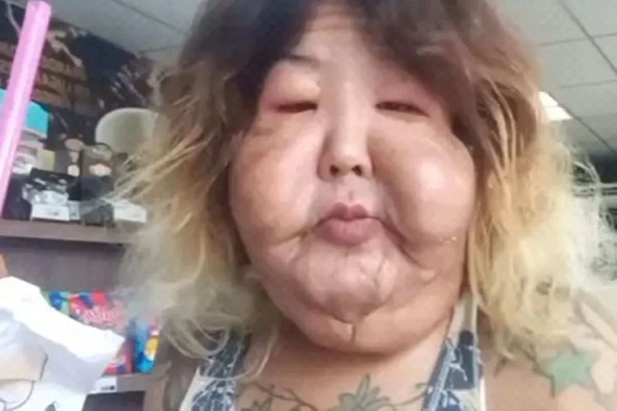 A aplicação de óleo mineral provocou deformações evidentes na face dela, alteração que se agravou com o tempo.