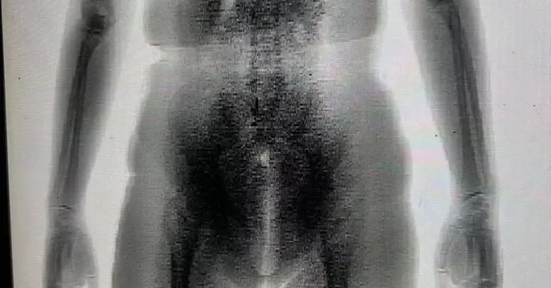 Imagem do BodyScan revela volume atípico no corpo da mulher durante revista no presídio.