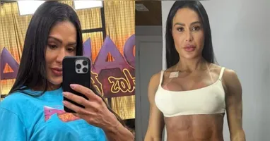 Gracyanne Barbosa usou as redes sociais para mostrar o antes e depois do corpo dela após passar por uma cirurgia.