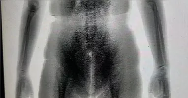 Imagem do BodyScan revela volume atípico no corpo da mulher durante revista no presídio.
