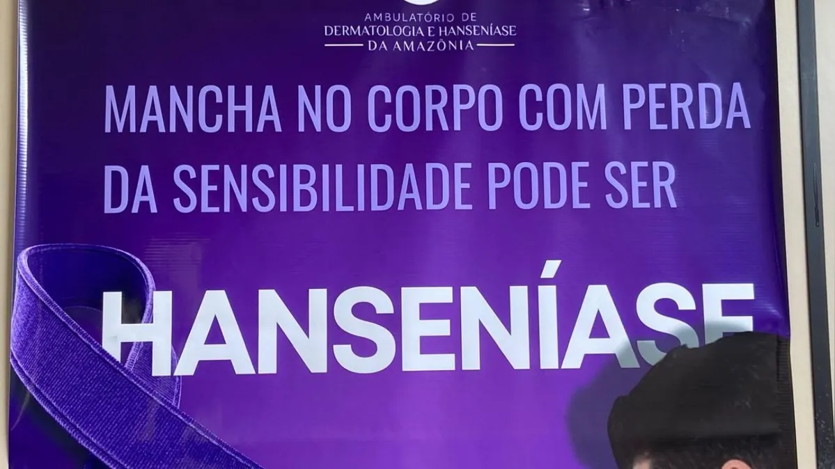 Imagem ilustrativa da notícia Roda Hans oferece diagnóstico precoce de hanseníase em Marabá