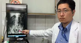 Médico mostra raio-X que mostra a xícara dentro do paciente