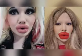 Andrea Ivanova, de 28 anos, exibindo o resultado dos preenchimentos labiais que lhe renderam fama internacional.