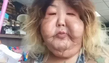 Imagem ilustrativa da imagem Veja como era Juju do Pix antes de aplicar óleo mineral no rosto