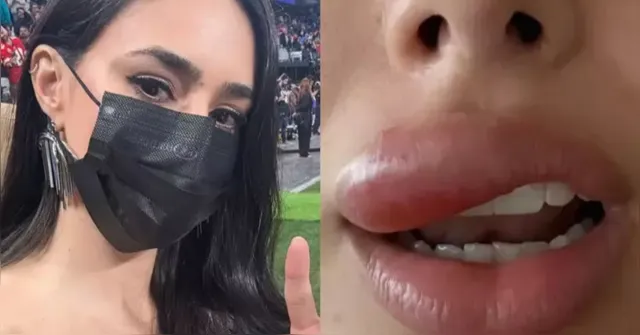 Imagem ilustrativa da notícia Bruna Biancardi sofre com inchaço facial após espremer espinha