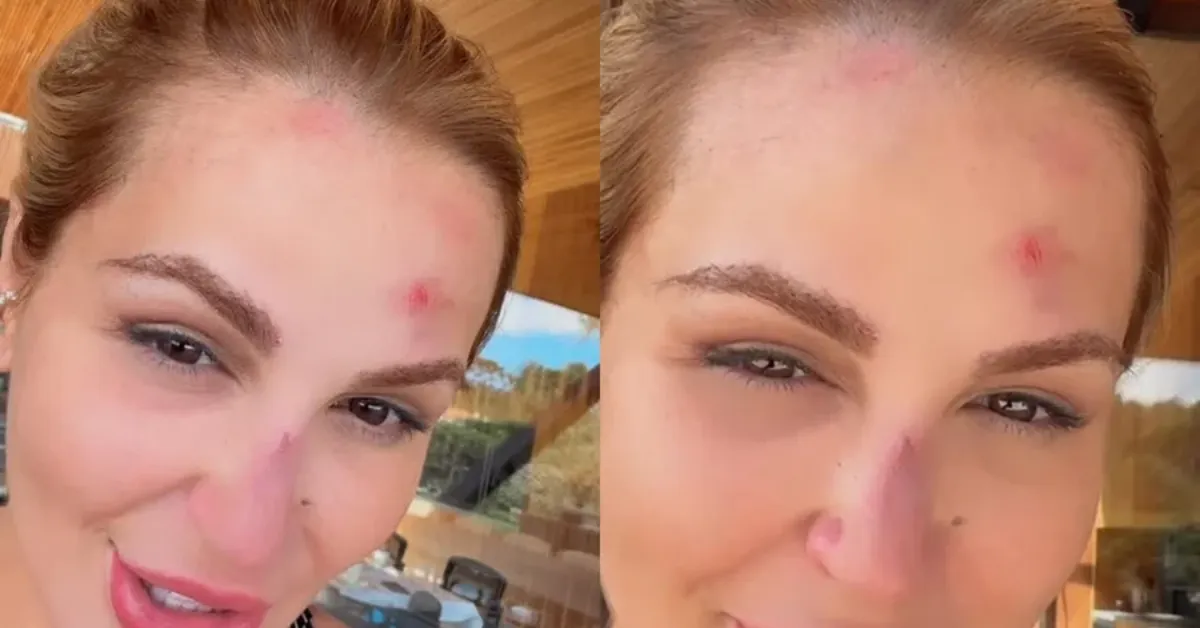 Deolane Bezerra mostra ferimentos após acidente doméstico e alerta seguidores sobre cuidados dentro de casa.