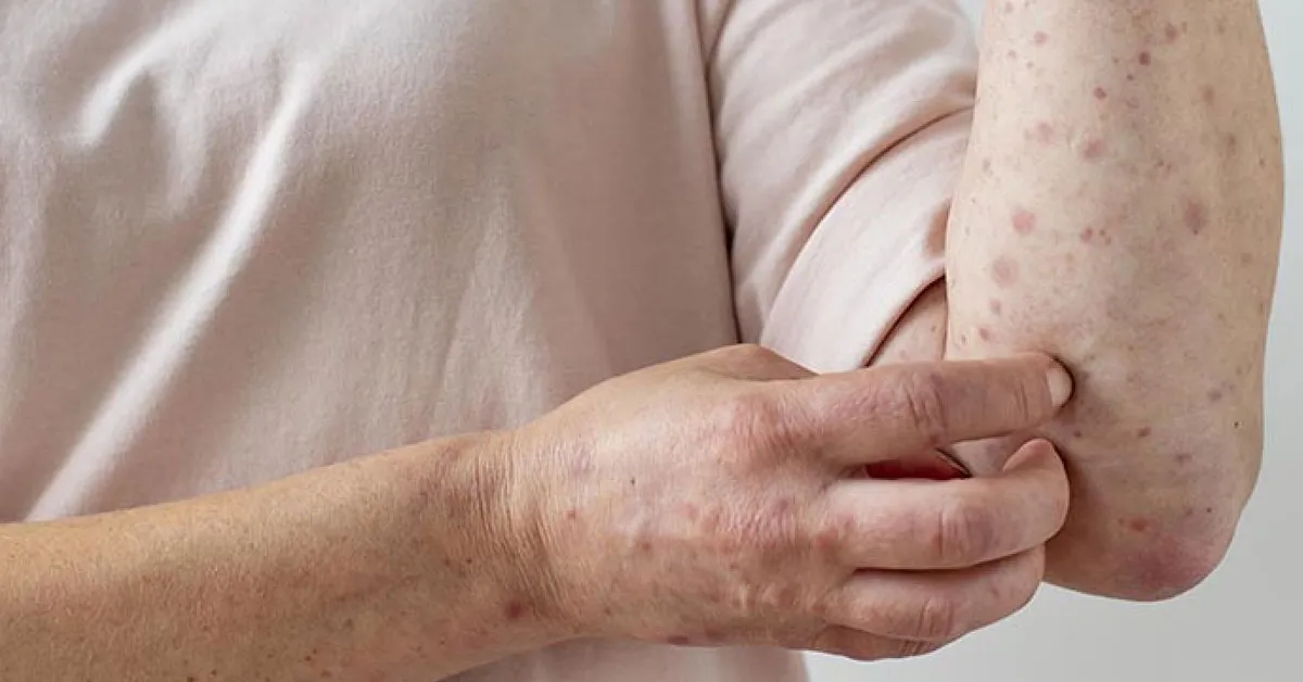 A mpox é causada pelo vírus MPXV, do gênero Orthopoxviru