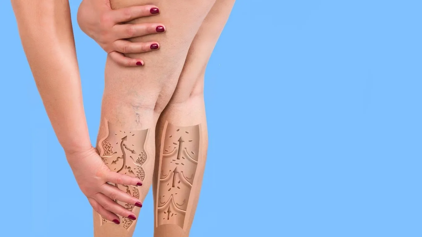 O lipedema não é apenas uma questão de aparência; é uma condição que limita a rotina e afeta diretamente a saúde mental