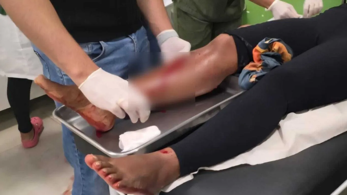 Perna direita da vítima após ser atingida por disparo de arma de fogo na noite de sábado (13), em Tucumã, no sul do Pará.