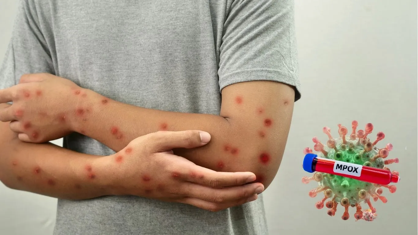 O Ministério da Saúde acendeu o sinal de alerta para o avanço da mpox em território nacional.