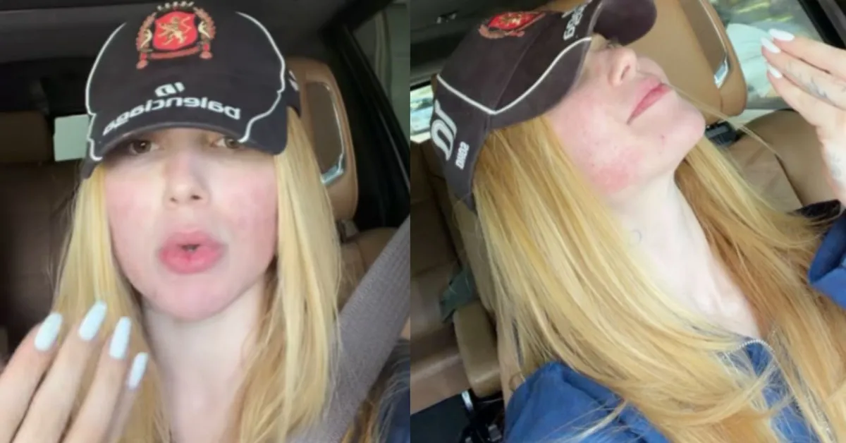 Virginia Fonseca apareceu nas redes sociais com o rosto visivelmente sensível após procedimento estético.