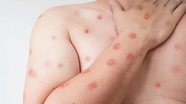 Caso de Mpox é confirmado em Porto Alegre. Veja os sintomas da doença e como se prevenir!