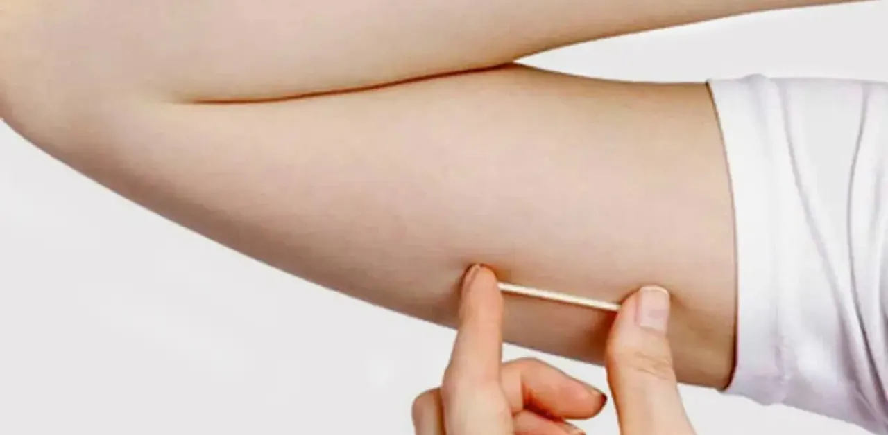 Pará: implante contraceptivo que custa até R$ 4 mil é incorporado no SUS.