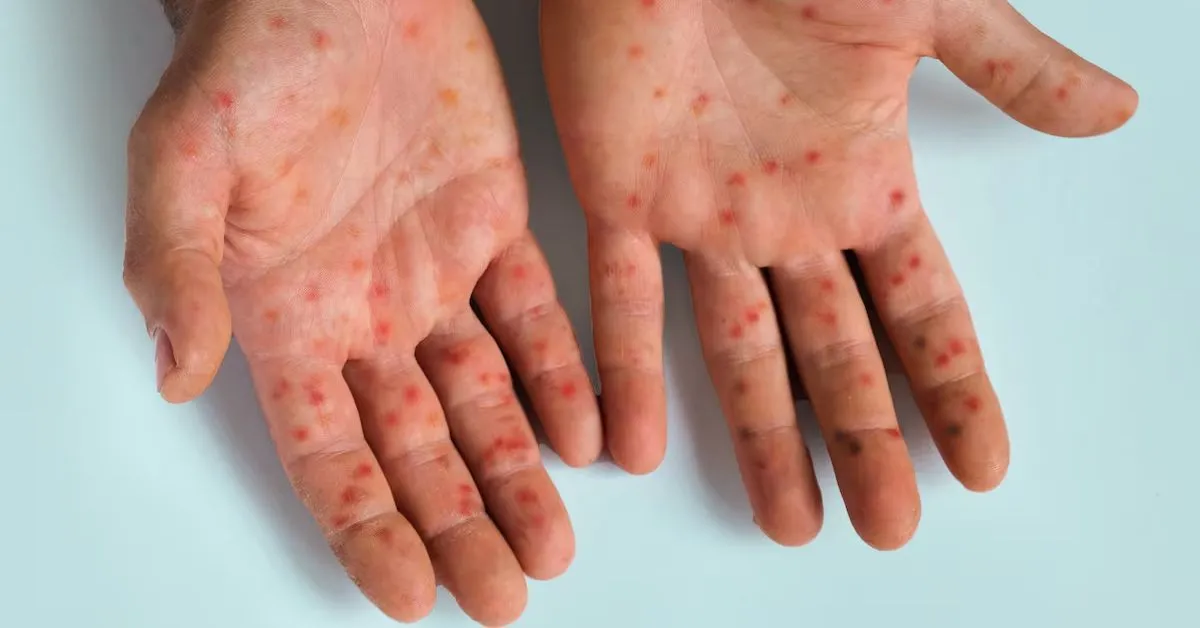 Vírus voltou a gerar dúvidas nas buscas na internet sobre diagnóstico e tratamento