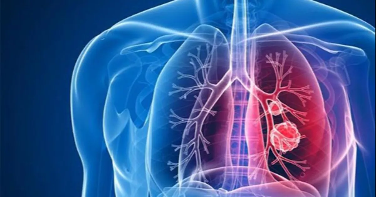 A tuberculose é causada pela bactéria Mycobacterium tuberculosis, transmitida principalmente pelo ar, quando uma pessoa infectada tosse, espirra ou fala.