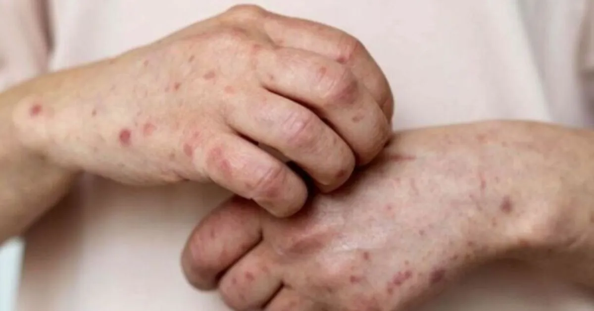 As lesões cutâneas representam o principal sinal clínico da mpox. O processo de evolução dessas marcas segue etapas bem definidas.