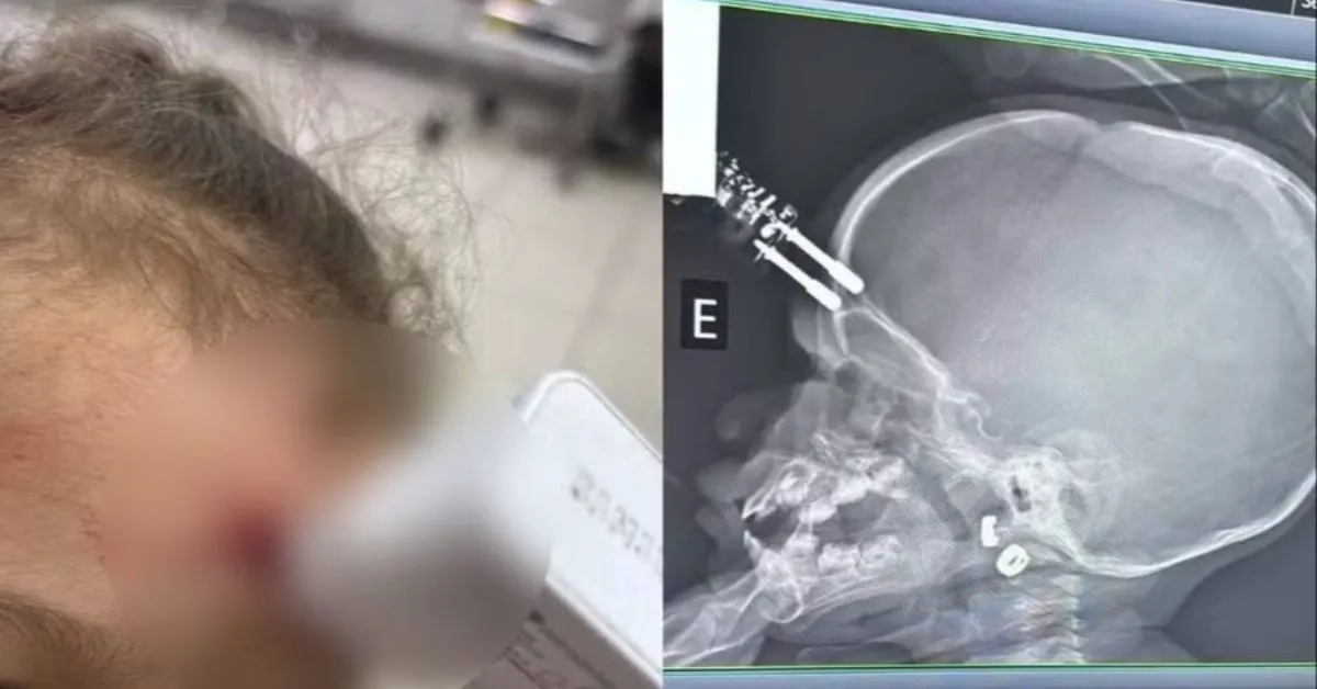 Exame de raio-X mostra o objeto cravado na testa da criança