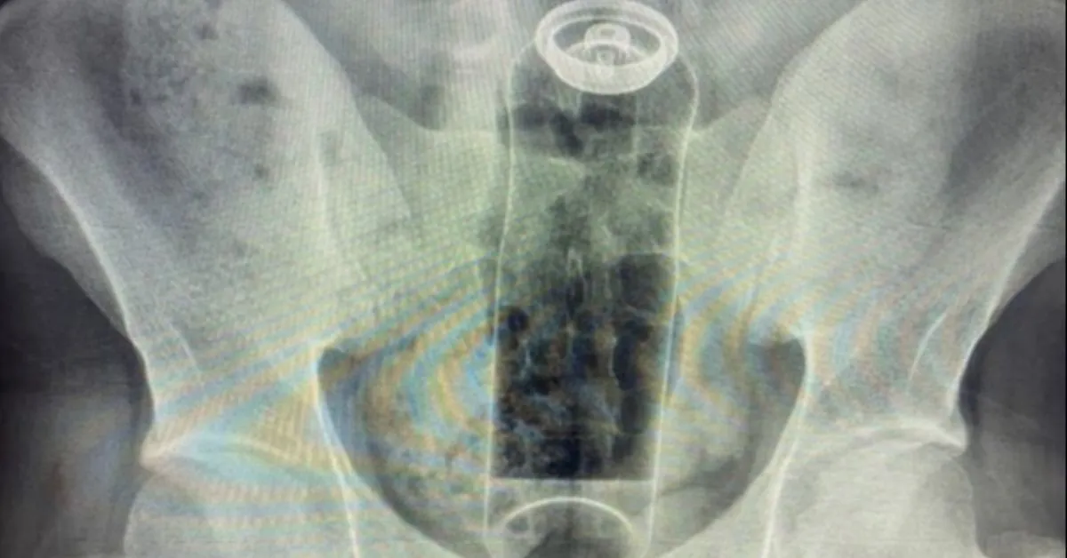 Médico mostra raio-X em que mostra o desodorante introduzido