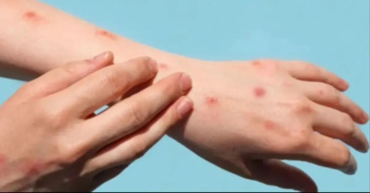 Alerta de casos de mpox continua no Brasil