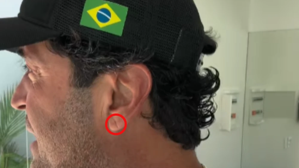 Sinal foi observado na orelha do influenciador Henrique Maderite, após ter sua morte confirmada em decorrência de um infarto.