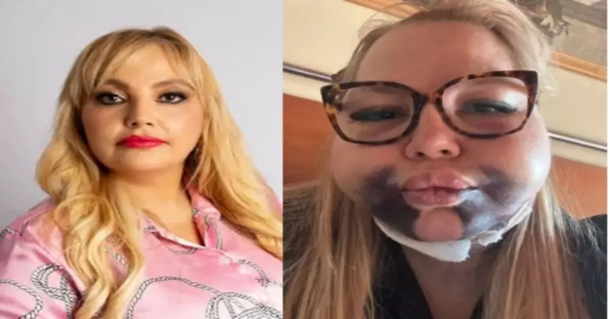 Advogada ficou internada por 12 dias após procedimento estético facial; dentista foi denunciada por lesão corporal grave.