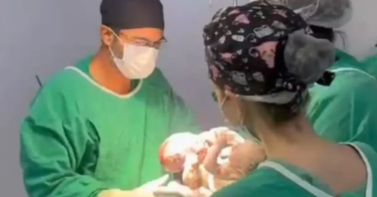 Caso classificado como raro mobilizou equipe médica especializada desde o nascimento dos gêmeos siameses Marcos e Mateus.