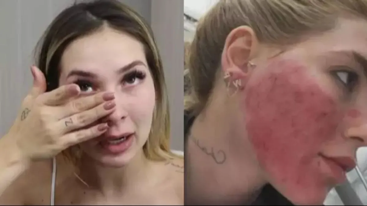 Aspecto da pele é uma reação normal após procedimentos estéticos realizados recentemente pela influenciadora.