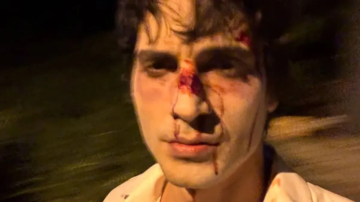 Fiuk compartilha imagem preocupante com rosto machucado e gera reações de fãs