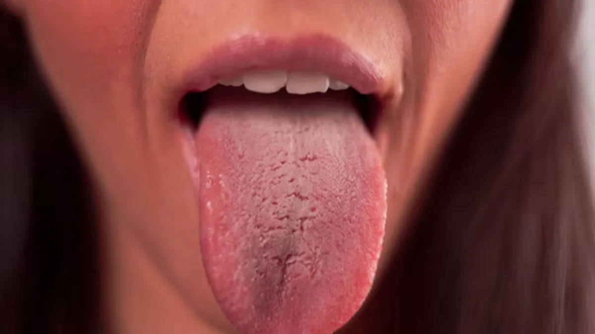 Imagem ilustrativa da notícia: Língua esbranquiçada? Veja os problemas de saúde que isso pode ser