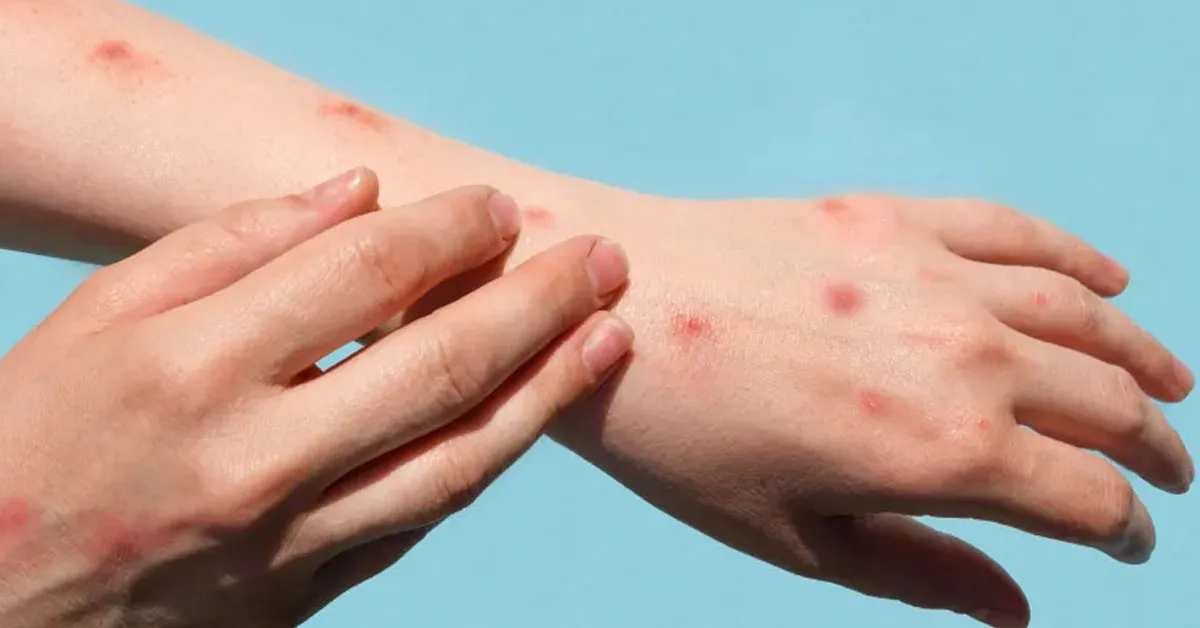 Após o pico registrado entre 2022 e início de 2023, a Mpox – anteriormente chamada de monkeypox – segue sob monitoramento das autoridades sanitárias.