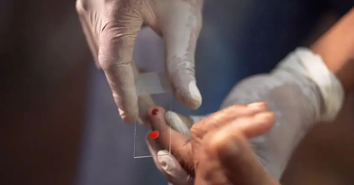 O público infantil concentra cerca de 50% dos casos da doença no país.