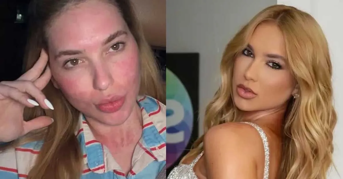 Virginia exibe rosto avermelhado após procedimentos estéticos e comenta recuperação nas redes sociais.