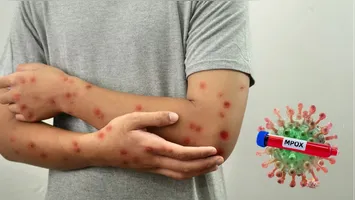 O Ministério da Saúde acendeu o sinal de alerta para o avanço da mpox em território nacional.