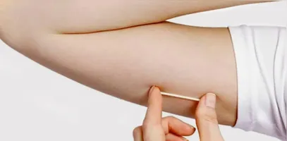 Pará: implante contraceptivo que custa até R$ 4 mil é incorporado no SUS.