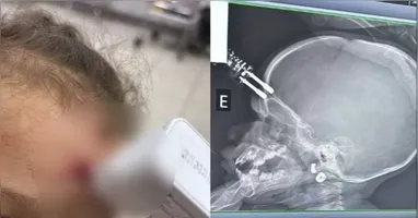 Exame de raio-X mostra o objeto cravado na testa da criança