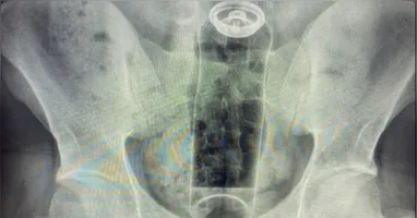 Médico mostra raio-X em que mostra o desodorante introduzido