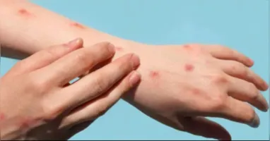 Alerta de casos de mpox continua no Brasil