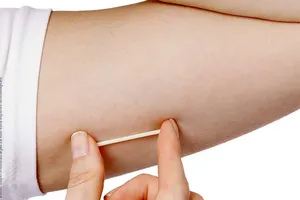 O Implanon é um importante método contraceptivo.