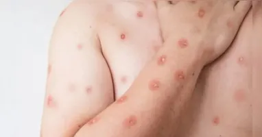 Mpox: além das confirmações, há 570 casos sob investigação, e 7 classificados como prováveis.