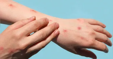 Após o pico registrado entre 2022 e início de 2023, a Mpox – anteriormente chamada de monkeypox – segue sob monitoramento das autoridades sanitárias.