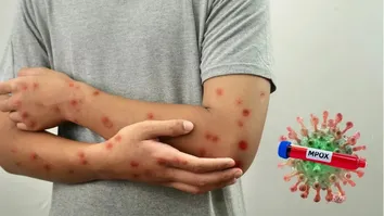 Mpox: os sintomas incluem febre, mal-estar e o surgimento de lesões na pele.