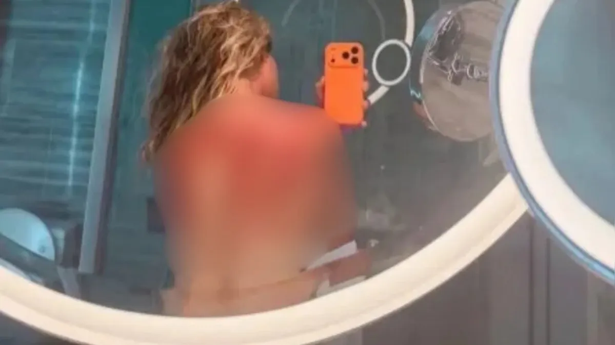 Imagem ilustrativa da notícia Tenista exibe queimaduras após jogo sob calor extremo na Austrália