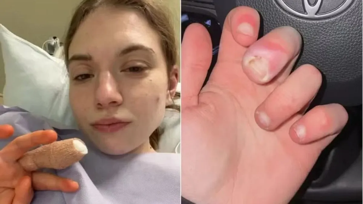 Imagem ilustrativa da notícia Hábito de roer unhas quase leva jovem à amputação de dedo