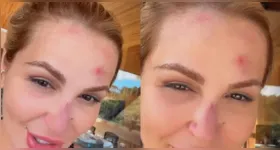 Deolane Bezerra mostra ferimentos após acidente doméstico e alerta seguidores sobre cuidados dentro de casa.