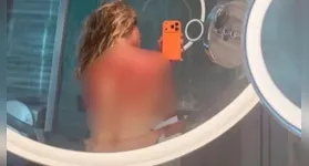 Registro publicado por Renata Zarazúa mostra vermelhidão e queimaduras nas costas após duelo em Hobart.