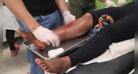 Perna direita da vítima após ser atingida por disparo de arma de fogo na noite de sábado (13), em Tucumã, no sul do Pará.