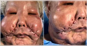 A influenciadora já avança na recuperação dos procedimentos estéticos.